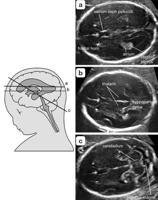 Узи мозга плода. Нейросонография УЗИ анатомия. Анатомические структуры мозга плода на УЗИ. Задние рога боковых желудочков плода норма. Ультразвуковая анатомия головного мозга плода.