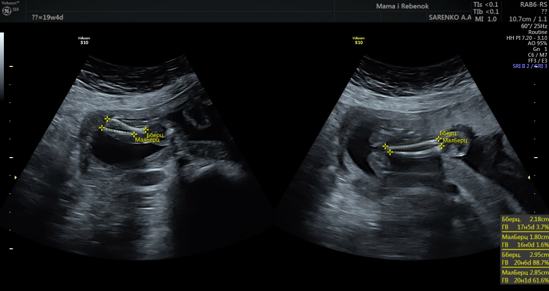 19 неделя 2023. УЗИ 19-20 недель беременности. УЗИ на 19 неделе беременности пол. Фото УЗИ 19-20 недель беременности.