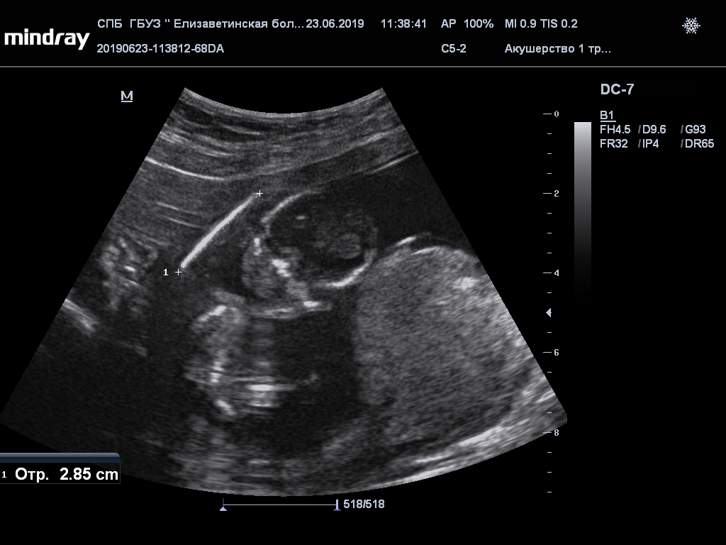 Беременность 13 мм. 13-14 Недель беременности.