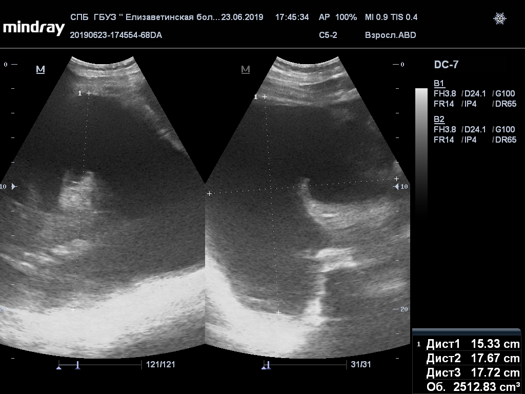 Асцит на узи. Правосторонний гидроторакс УЗИ. Левосторонний гидроторакс на УЗИ. Гидроторакс легких на УЗИ.
