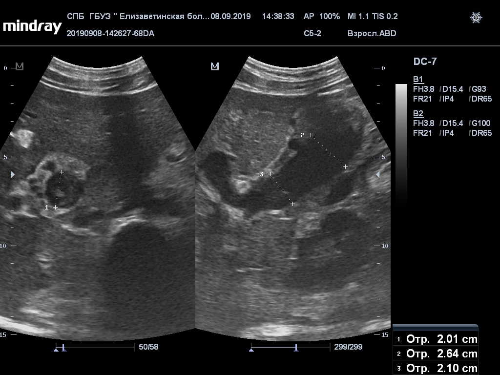 Тромбоз вен печени. Тромбоз селезеночной вены на УЗИ. Тромбоз воротной вены на УЗИ. Дилатация воротной вены на УЗИ. Тромбоз селезеночной вены на кт.