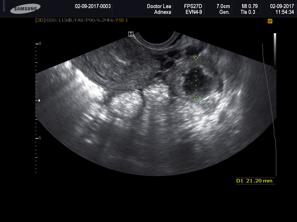 Внематочная эндометрий. Внематочная Трубная беременность УЗИ. Прерванная Трубная беременность. Трубная беременность УЗИ. Внематочная беременность на УЗИ.