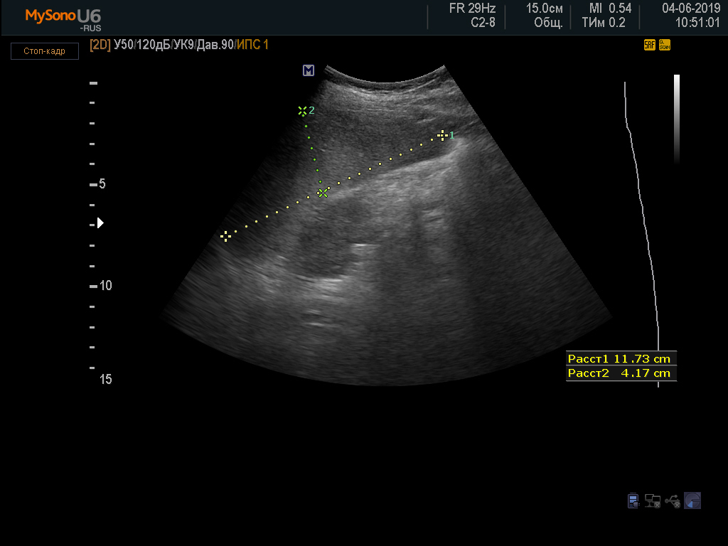 Узи сосудов печени
