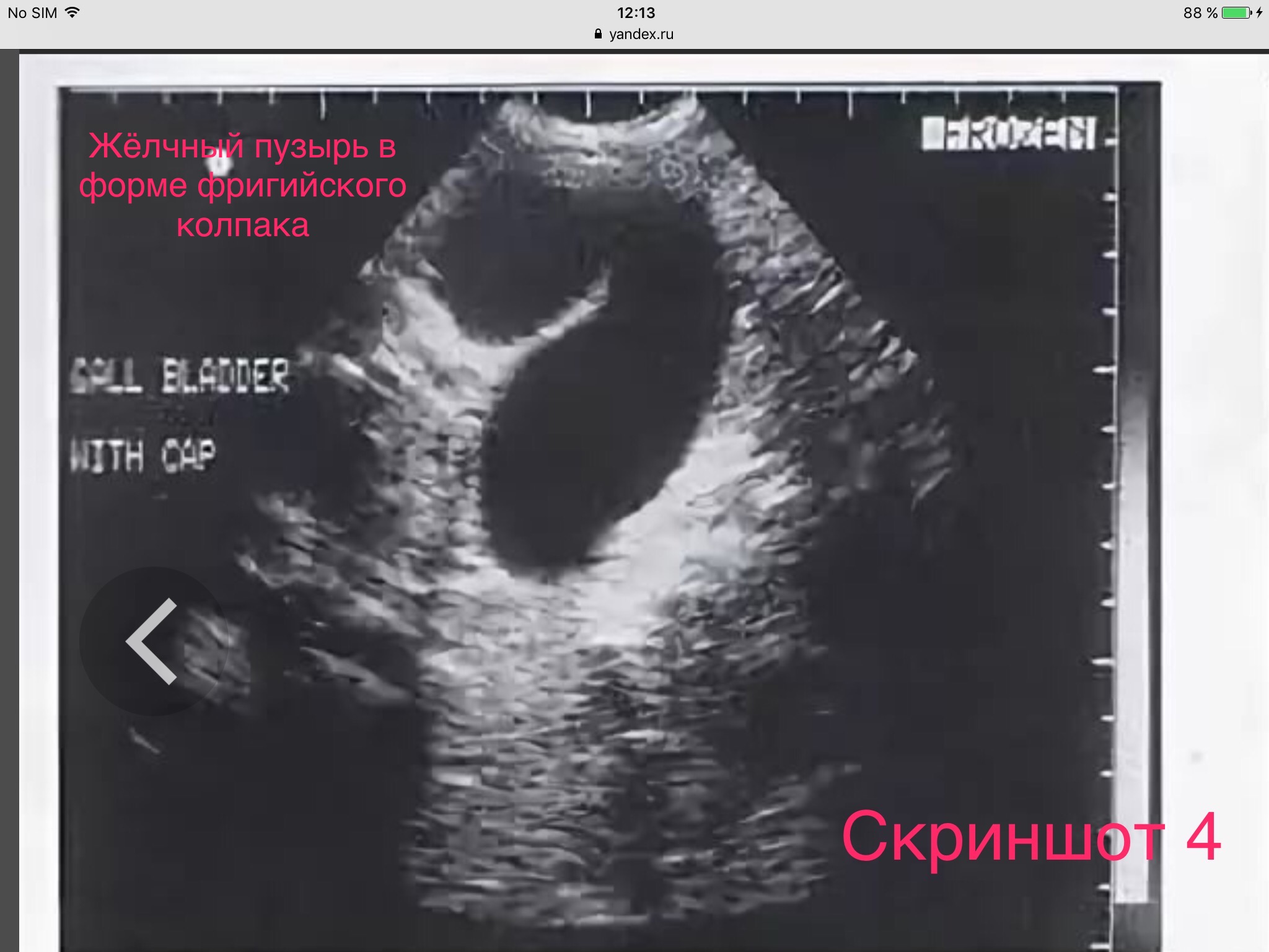 S образный желчный пузырь что находится справа сзади в боку у женщины