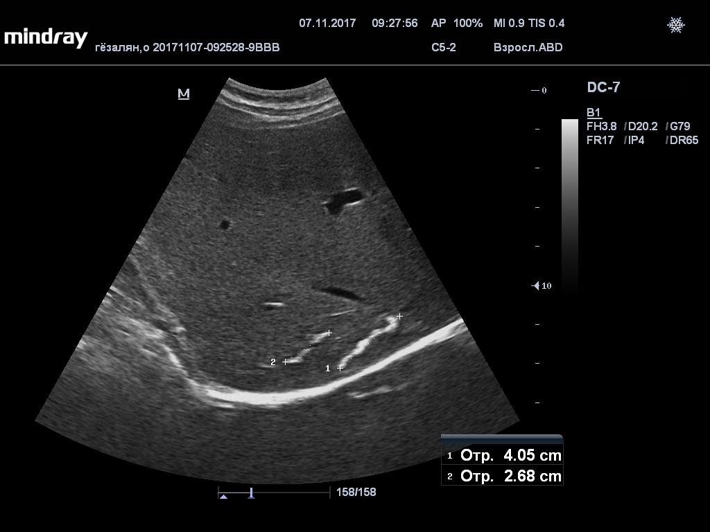 Размеры печени по узи у взрослых