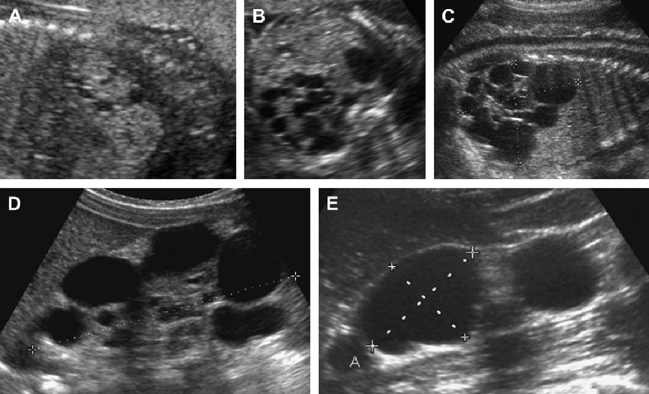 Почки у плода 20 недель. Аутосомно-рецессивная поликистозная болезнь почек УЗИ. Мультикистозная дисплазия почки. Поликистоз почки аномалия.