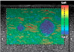 Real-time Tissue Elastography