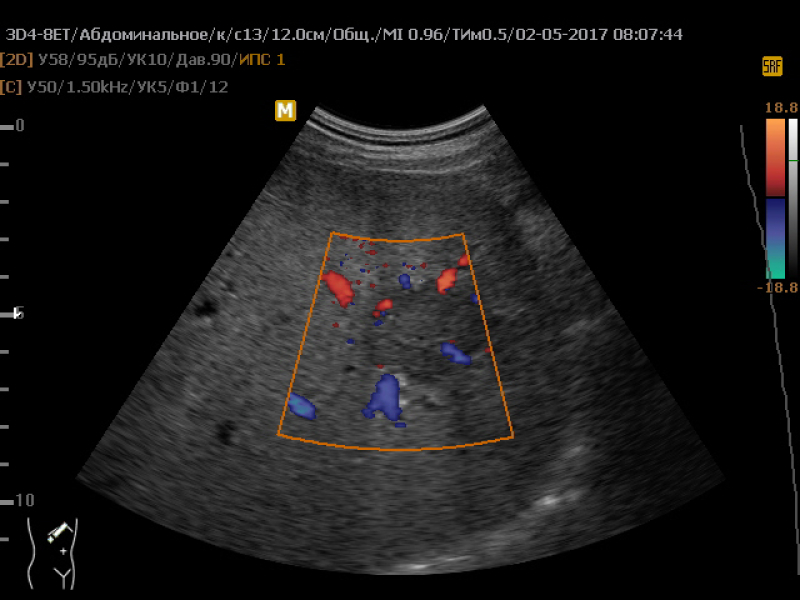 Образование в печени на узи