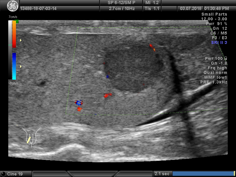 Узи придатка яичка. Образование придатка яичка УЗИ. Образования мошонки на УЗИ.