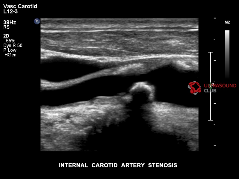 Узи атеросклероз. Атеросклероз сонных артерий УЗИ. Бляшки в сонной артерии УЗИ. УЗИ дуплексное сканирование сонных артерий. Стеноз общих сонных артерий УЗИ.
