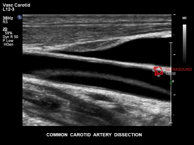 Узи атеросклероз. Диссекция сонной артерии на УЗИ. Диссекция сосудов шеи на УЗИ. Аневризма сонной артерии УЗИ. Расслоение сонной артерии на УЗИ.