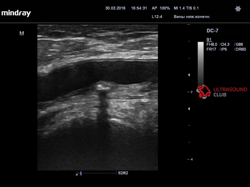 Узи атеросклероз. Стеноз артерий нижних конечностей на УЗИ. Атеросклероз сосудов шеи УЗИ. Атеросклеротическая бляшка УЗИ. УЗИ сонных артерий.