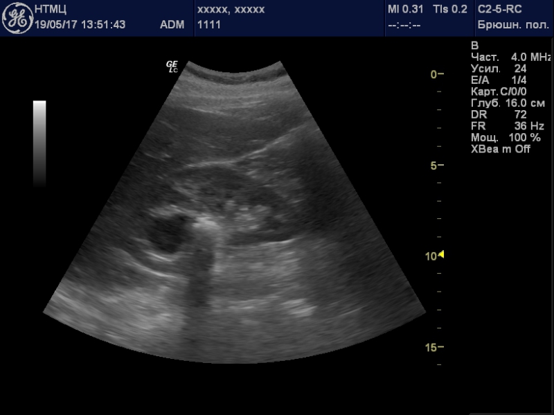 Конкремент латынь. Конкремент лоханки УЗИ. Мелкий конкремент левой почки. Конкременты правой почки почек.