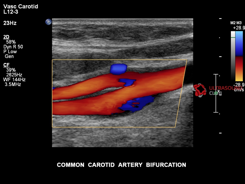 Узи атеросклероз. Ультразвуковая допплерография экстракраниальных сосудов. Атеросклероз сонных артерий УЗИ. Бифуркация общей сонной артерии на УЗИ. УЗИ УЗДГ брахиоцефальных сосудов.