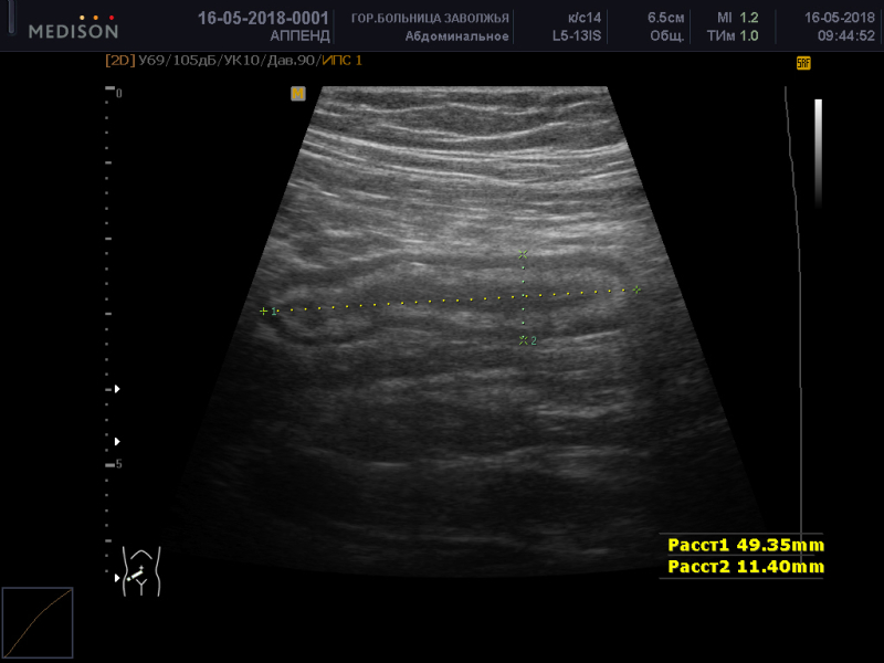 На узи видно аппендицит. УЗИ диагностика острого аппендицита. УЗИ признаки острого аппендицита. УЗИ червеобразного отростка. УЗИ признаки аппендицита.