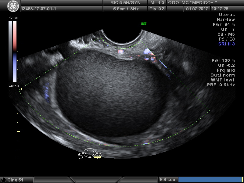 Киста 8 мм. Эндометриоидная киста яичника. Эндометриоидная киста яичника на УЗИ. Киста яичника снимок УЗИ. Эндометриоидная киста яичника ЦДК.