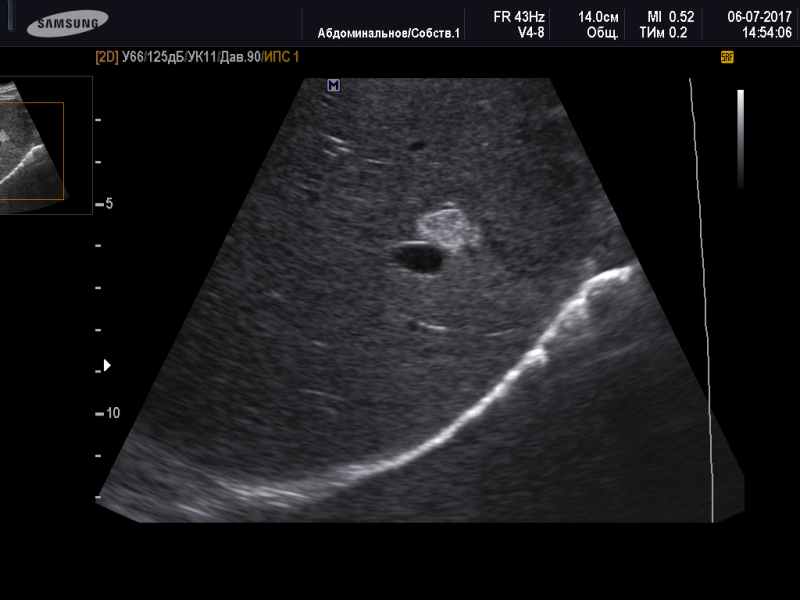 Чем лечить кисту левой доли печени. Кавернозная гемангиома печени на УЗИ. Гистогенез гемангиомы печени. УЗИ картина кавернозной гемангиомы печени. Что такое гемангиома в 6 сегменте печени.