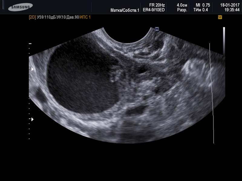 Киста яичника o rads. Фолликулярная киста яичника. Фолликулярная киста яичника на УЗИ. Киста желтого тела это o-rads 2&. Эндометриоидная киста яичника.
