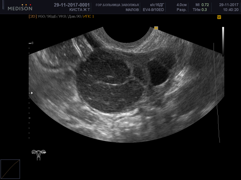 Киста в менопаузе лечение. Фолликулярная киста яичника на УЗИ. Мультилокулярная киста яичника. Киста желтого тела яичника на УЗИ. Геморрагическая киста и эндометриоидная киста.