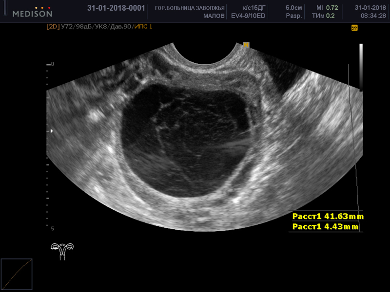 Киста 8 мм. Киста яичника 44мм на 43 мм.
