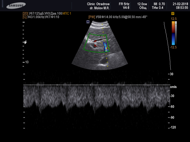 Доплер кровотоки. Кровоток в воротной Вене на УЗИ. УЗДГ сосудов воротной вены. УЗИ допплерография воротной вены. УЗИ допплерография портального кровотока печени.