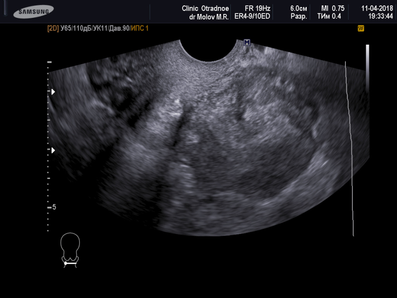 Матка увеличена до 6 недель. Множественная миома матки УЗИ.