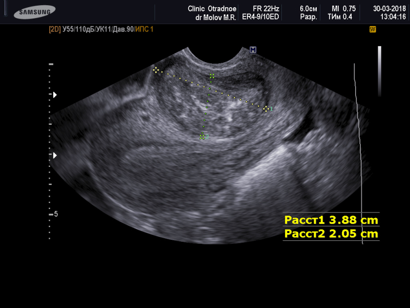 Эндометрий 4 2. Миома матки малых размеров на УЗИ. Миома и беременность на УЗИ.