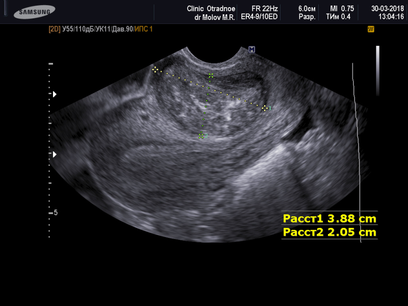 На узи видно шейку матки. Миома матки малых размеров на УЗИ. Миома и беременность на УЗИ.