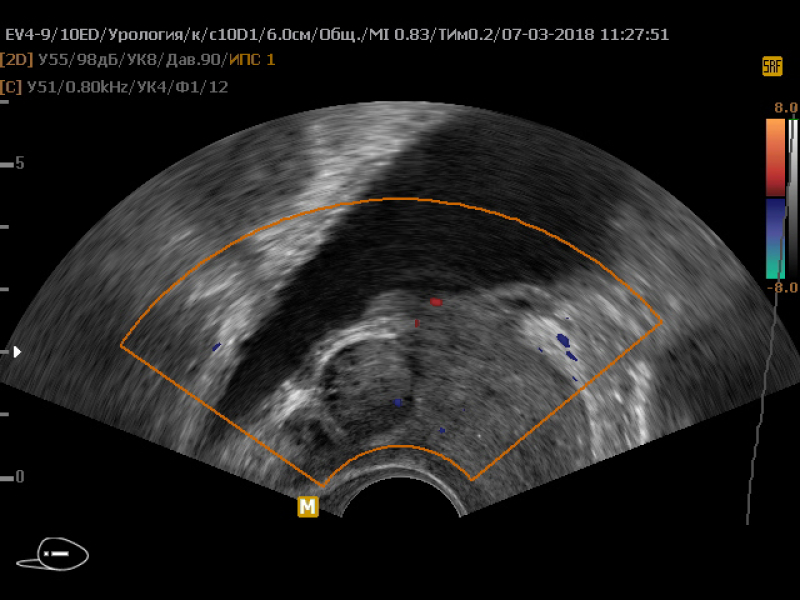 Очаговые изменения предстательной железы. Образования предстательной железы на УЗИ. ЦДК предстательной железы. Зональная анатомия предстательной железы УЗИ.