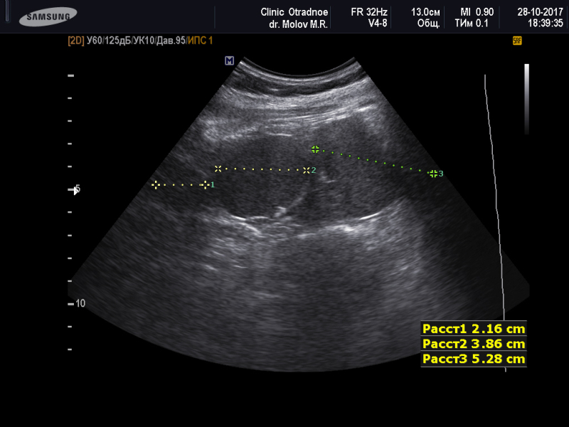 Три селезенки. Добавочная долька селезенки на УЗИ. Дольчатая селезенка на УЗИ. Удвоение селезенки на УЗИ.