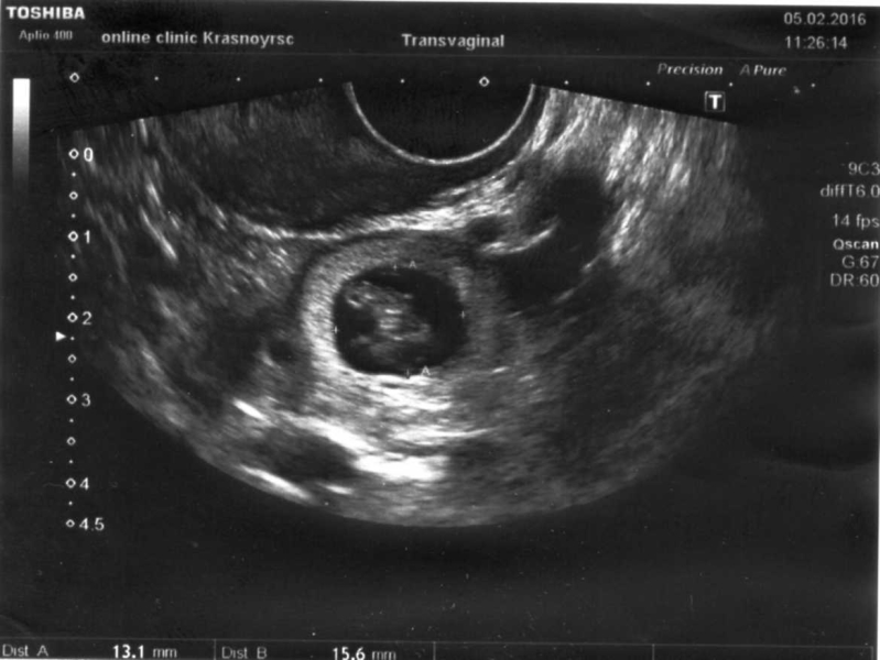 Болит яичник во время беременности. Внематочная беременность 6 недель УЗИ. Внематочная беременность УЗИ 7 недель. Внематочная беременность 6-7 недель. Внематонаябеременность 6 недель.