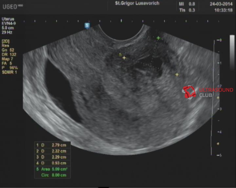 Узи при миоме матки на какой день. Узиекроз миоматозного узла. Некроз миоматозного узла на УЗИ.