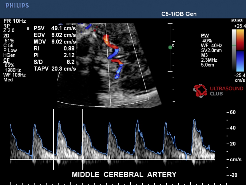Доплер это во время. Допплерометрия средней мозговой артерии плода. Показатели допплерометрии кровотока. УЗИ допплерометрия маточных артерий. Средняя мозговая артерия плода допплер.