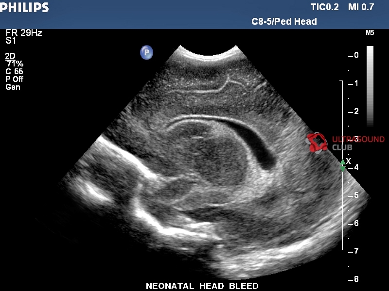 Узи головного мозга как подготовиться. УЗИ головного мозга нейросонография. Субарахноидальное кровоизлияние на УЗИ. ВЖК 1 степени у новорожденных УЗИ. Нейросонография кровоизлияние УЗИ.