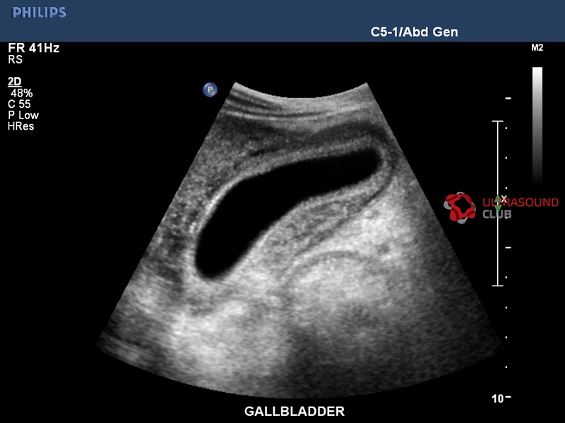 Эхо признаки желчного пузыря