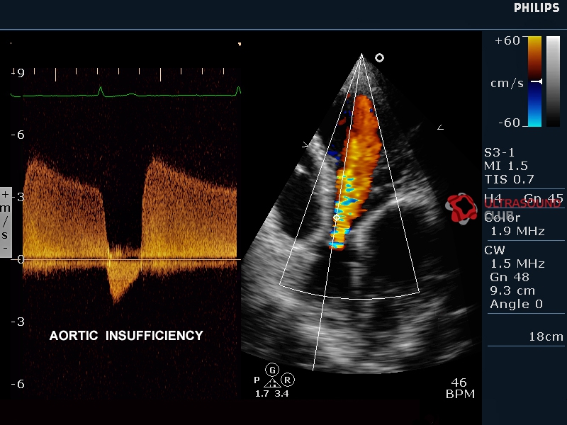 Допплерография ребенку. ЭХОКГ при аортальной недостаточности. Митральная недостаточность эхокардиография. Митральная недостаточность доплер эхокардиография. Аортальный стеноз допплер ЭХОКГ.
