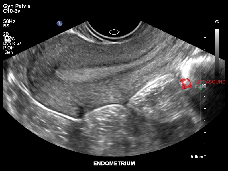 Эндометрий у девочек. Полип полости матки на УЗИ.