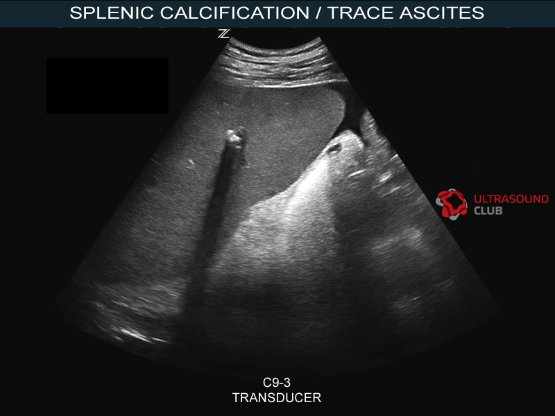 Кальцинаты в печени что это такое. Кальцинаты в селезенке на УЗИ. Спленомегалия на УЗИ.