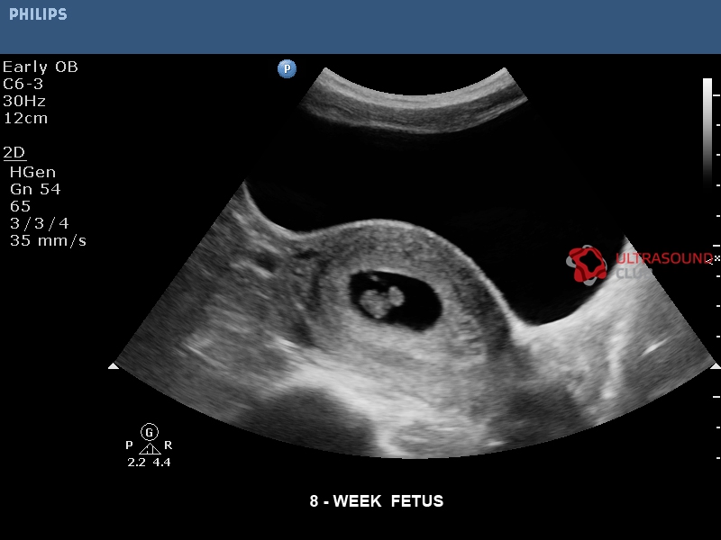 Узи плода 8 неделе