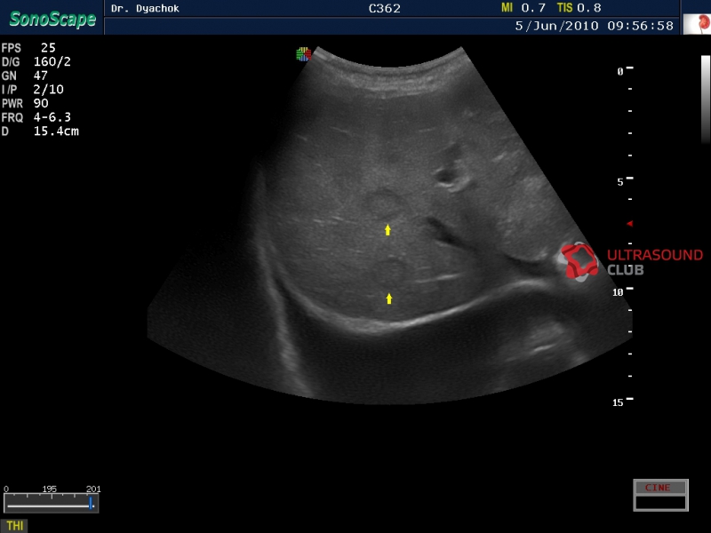 Холедох печени норма. Холедох анатомия УЗИ. Холедох печени норма по УЗИ. Холедох норма на УЗИ. SONOSCAPE SSI-6000.