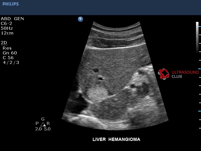 Очаговые гемангиомы печени. Гемангиома печени УЗИ признаки. Кавернозная гемангиома на УЗИ.