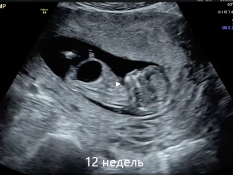 УЗИ 12 недель беременности. Эмбрион 12 недель УЗИ. УЗИ на 12 акушерской неделе. Плод на 12 неделе беременности УЗИ. Кости в 13 недель