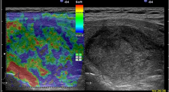 Эластография щитовидной железы что это. Эластография лимфатических узлов. Эластография щитовидной железы протокол. Магнитно резонансная эластография печени. Компрессионная эластография.