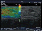 Elastography