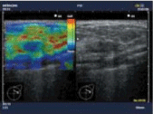 Elastography