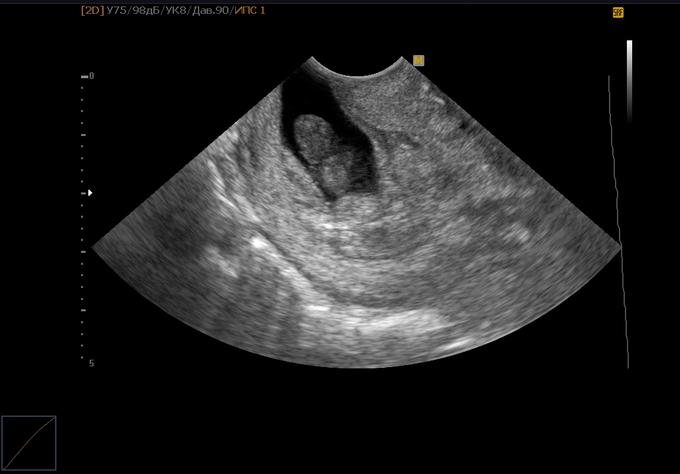 Узи на сроке 1 неделя. Ультразвуковое исследование беременности на ранних сроках. УЗИ на беременность на ранних сроках 1 неделя беременности. Снимки УЗИ на ранних сроках. Снимок УЗИ беременности на ранних сроках.