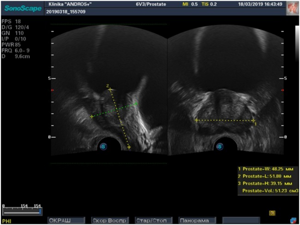 Узи простаты ректально