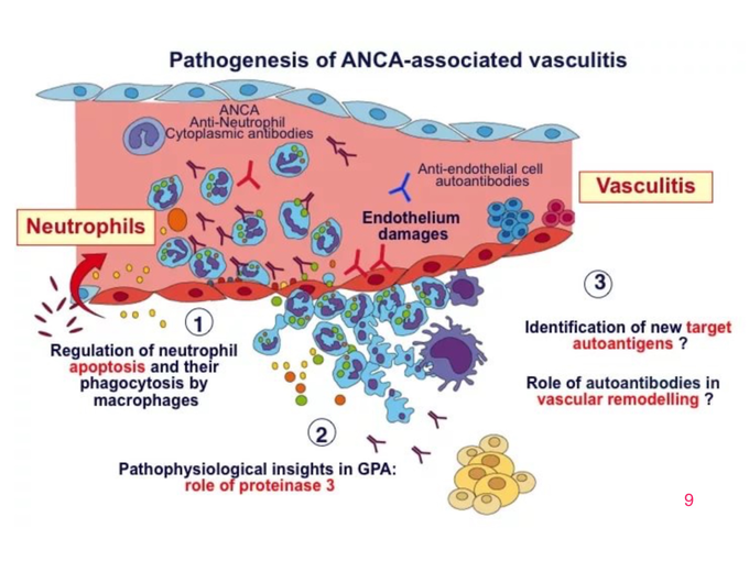 Васкулит патогенез. Гранулематоз Вегенера патогенез схема. АНЦА васкулит патогенез. Геморрагический васкулит патогенез схема. Васкулит системный. Гранулематоз Вегенера.