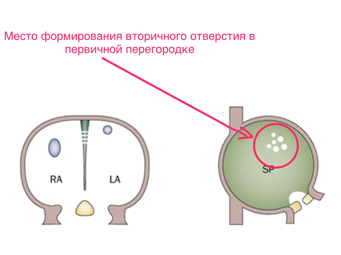 Дефект венозного синуса что это. Смотреть фото Дефект венозного синуса что это. Смотреть картинку Дефект венозного синуса что это. Картинка про Дефект венозного синуса что это. Фото Дефект венозного синуса что это