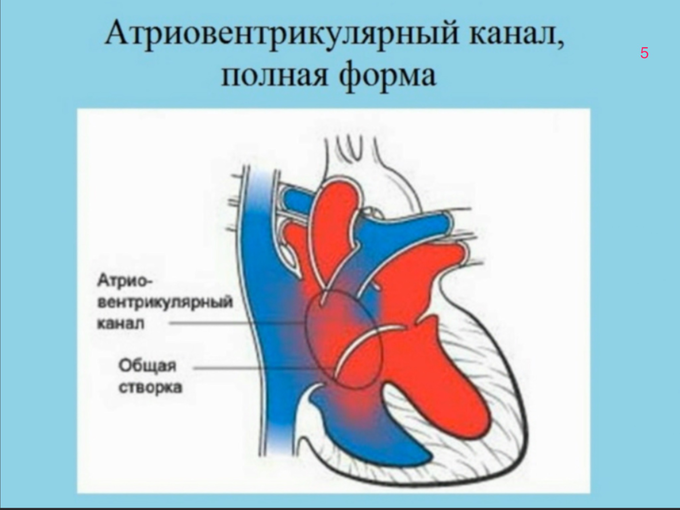 Врожденные пороки сердца АВК. Атриовентрикулярный канал клинические рекомендации. Дефект атриовентрикулярной перегородки. Атриовентрикулярная коммуникация полная форма. Av каналы